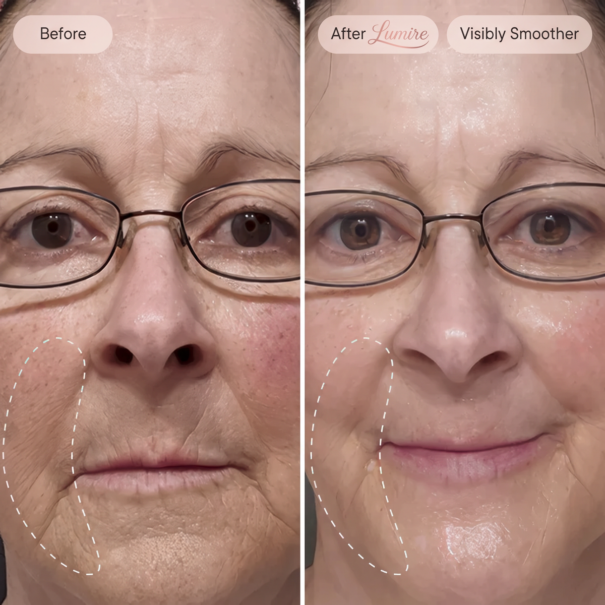 Micro-Infusion Rejuvenating Bundle