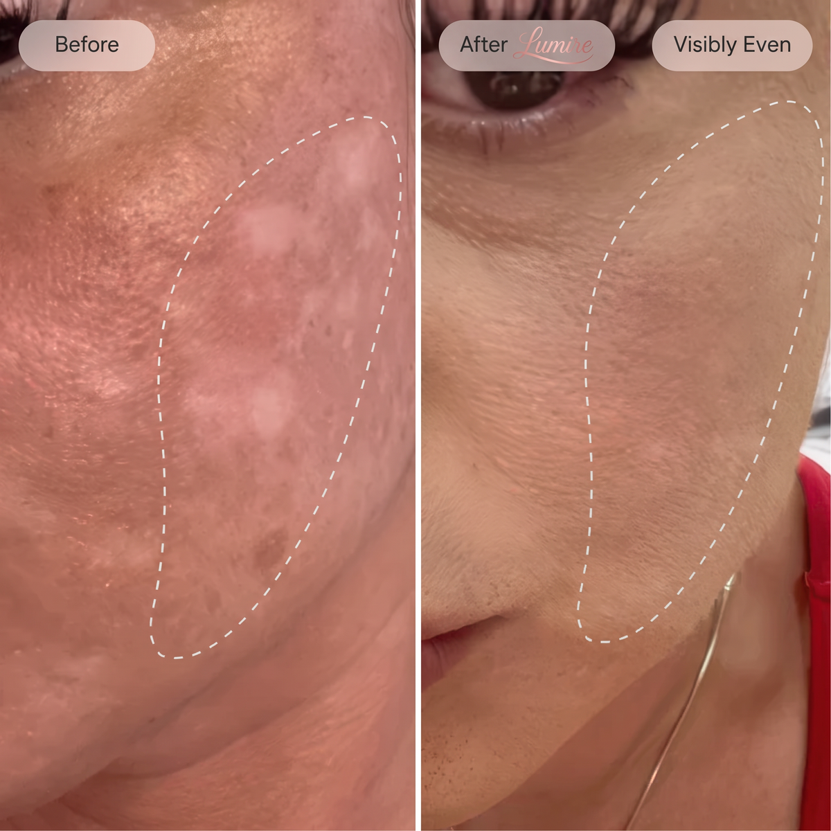 Micro-Infusion Rejuvenating Bundle