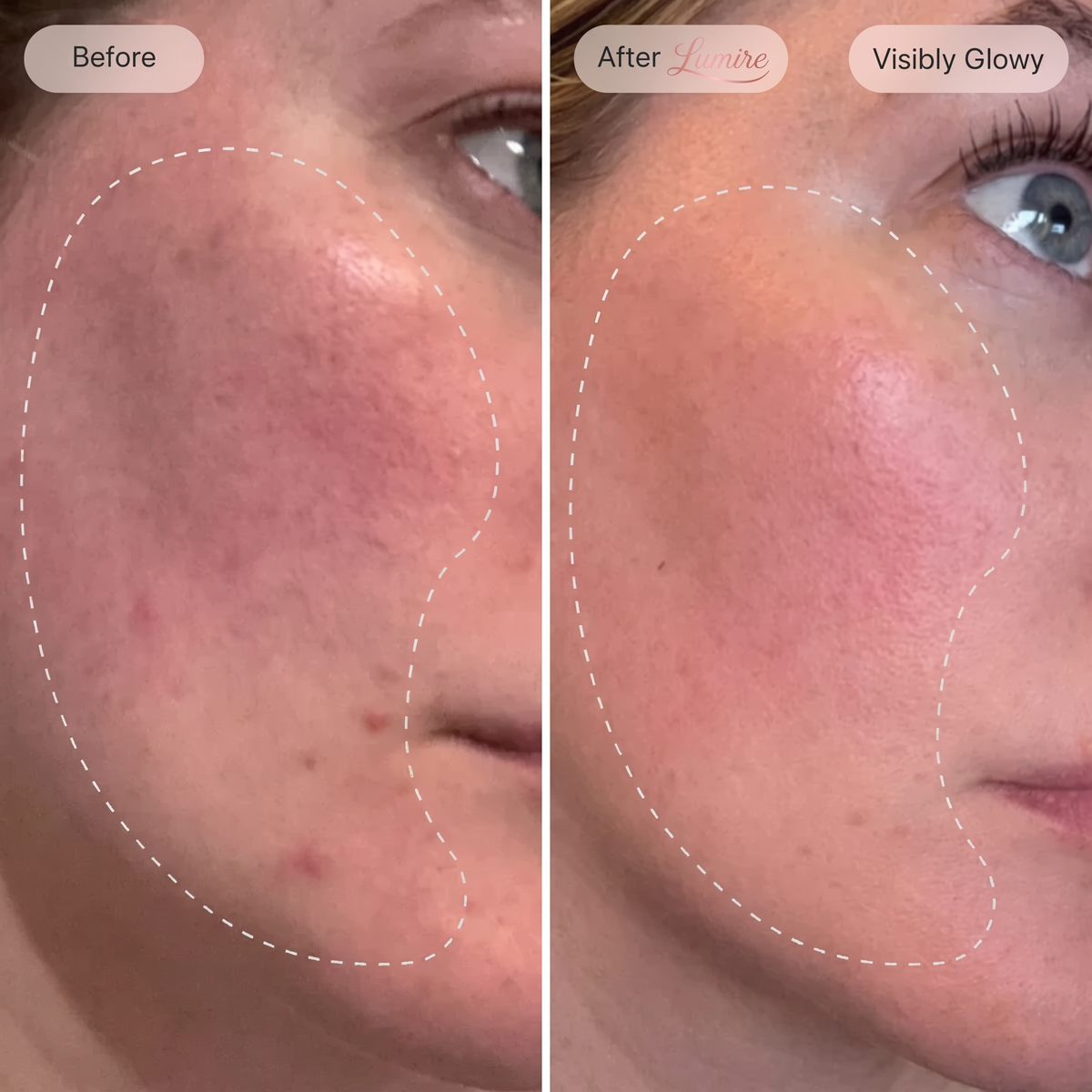 Micro-Infusion Rejuvenating Bundle